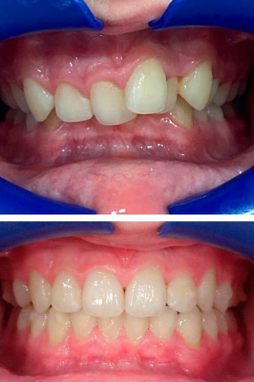 ortodoncia-adrian-antes-y-despues