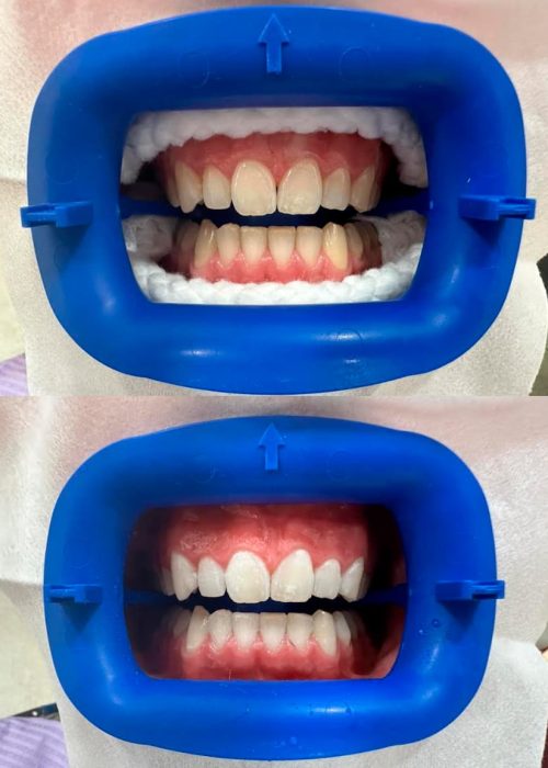 Blanqueamiento Dental Sevilla - Antes y Después Clínica Pododent