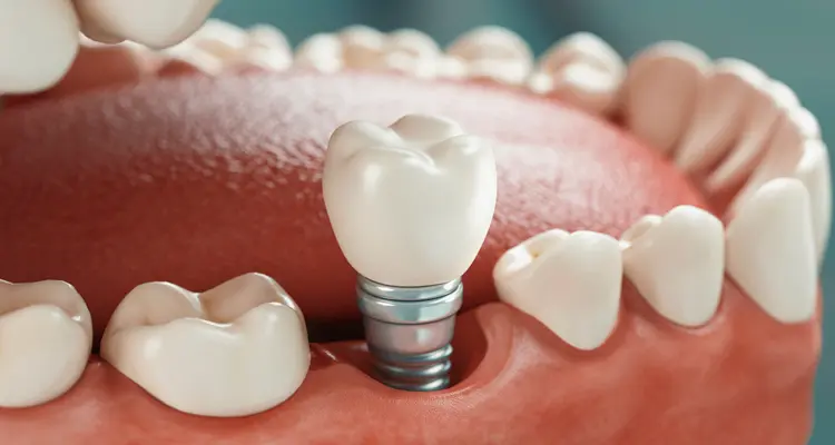 Implantes dentales