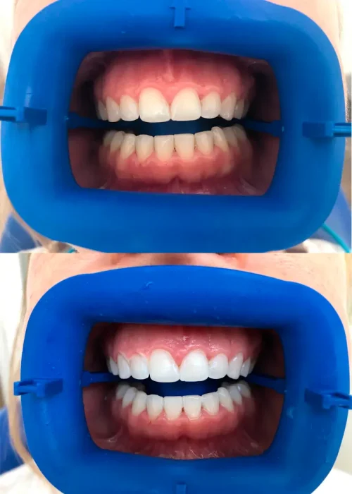 Antes y después blanqueamiento dental en Sevilla con Clínica Pododent