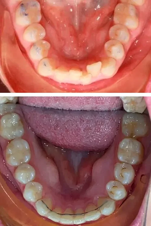 ejemplo-ortodoncia-antes-despues3