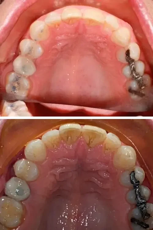 ortodoncia-antes-despues-2